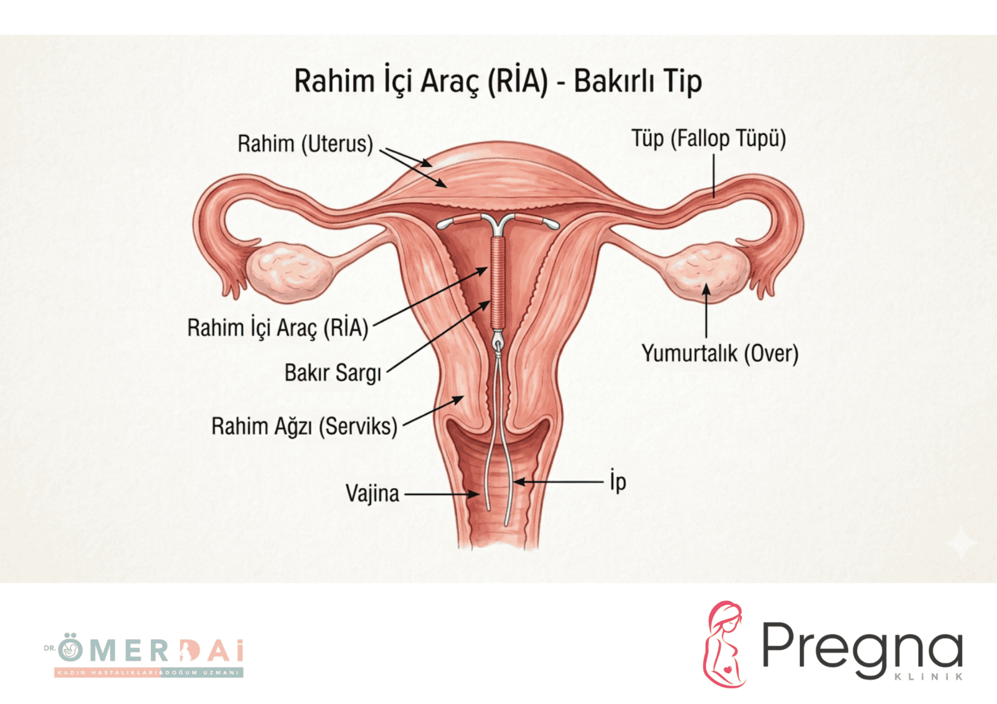 Rahim İçi Araç (Spiral) Nedir? Bakırlı ve Hormonlu Spiral Farkları – Gaziantep’te Uygulama