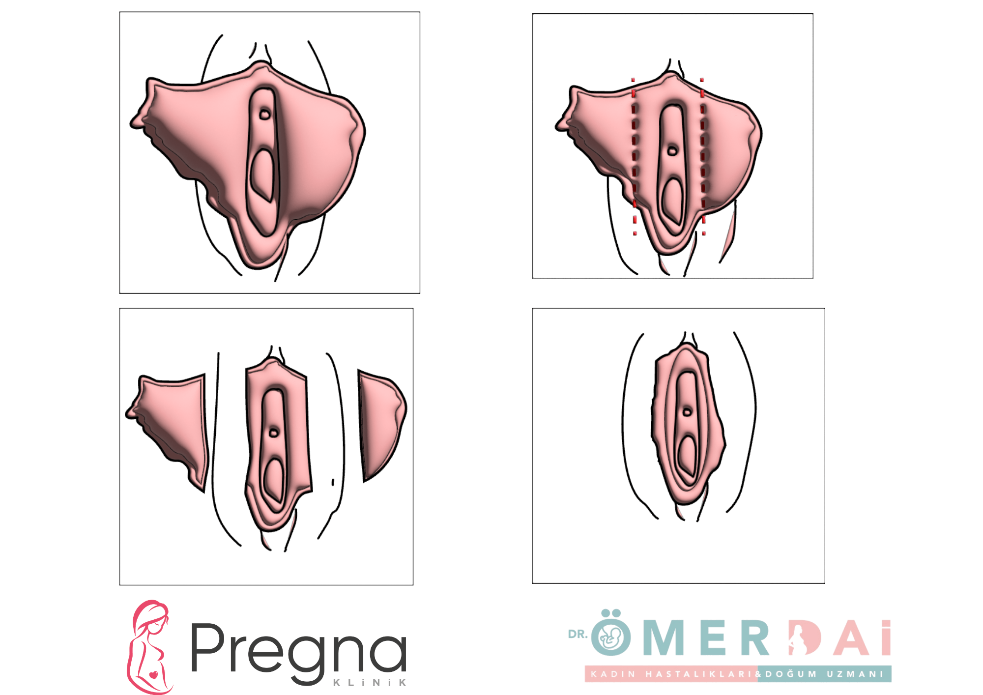 Labioplasti (Vajinal İç Dudak Estetiği) Nedir? Gaziantep’te Konforlu ve Kişiye Özel Çözümler
